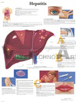 Hepatitis - Anatomical Chart